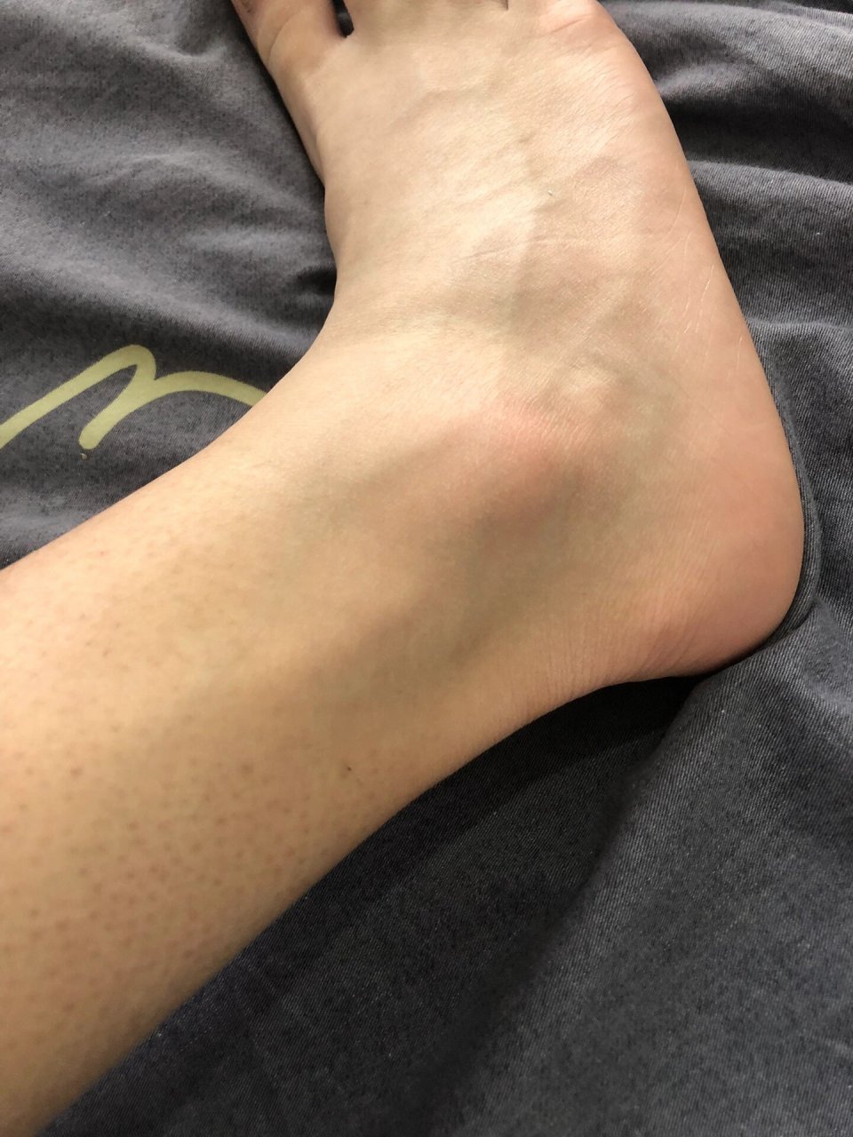 脚崴了一个月了拍了片骨头没问题为什么还是肿的正常吗希望懂医的小