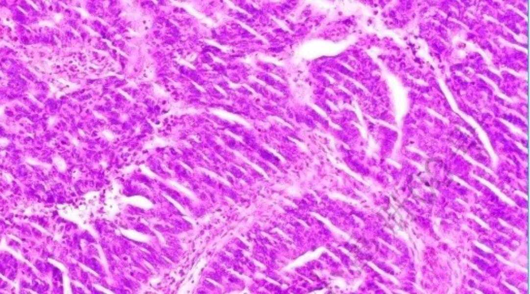 结肠腺癌 结肠腺癌 高峰年龄约60-79岁,男性较多见; 61大多数40岁