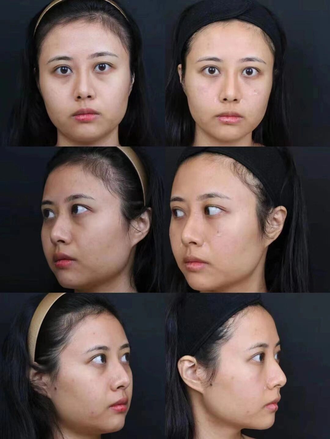 两边各1毫升,和大分子玻尿酸提升法令纹,打在鼻基底处,整体感觉还是不