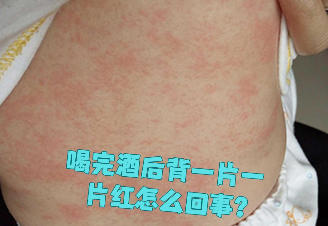 喝完酒后背一片一片红,这通常是酒精过敏的表现,有时还会伴随皮肤