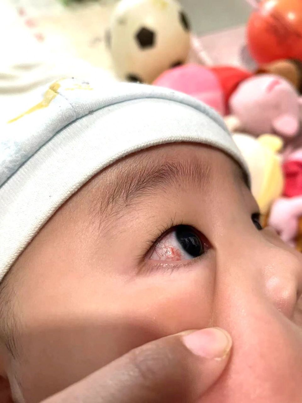 刚开始是一块红点一样,隔了一天感觉红血丝变多了,但是红点淡了一些.