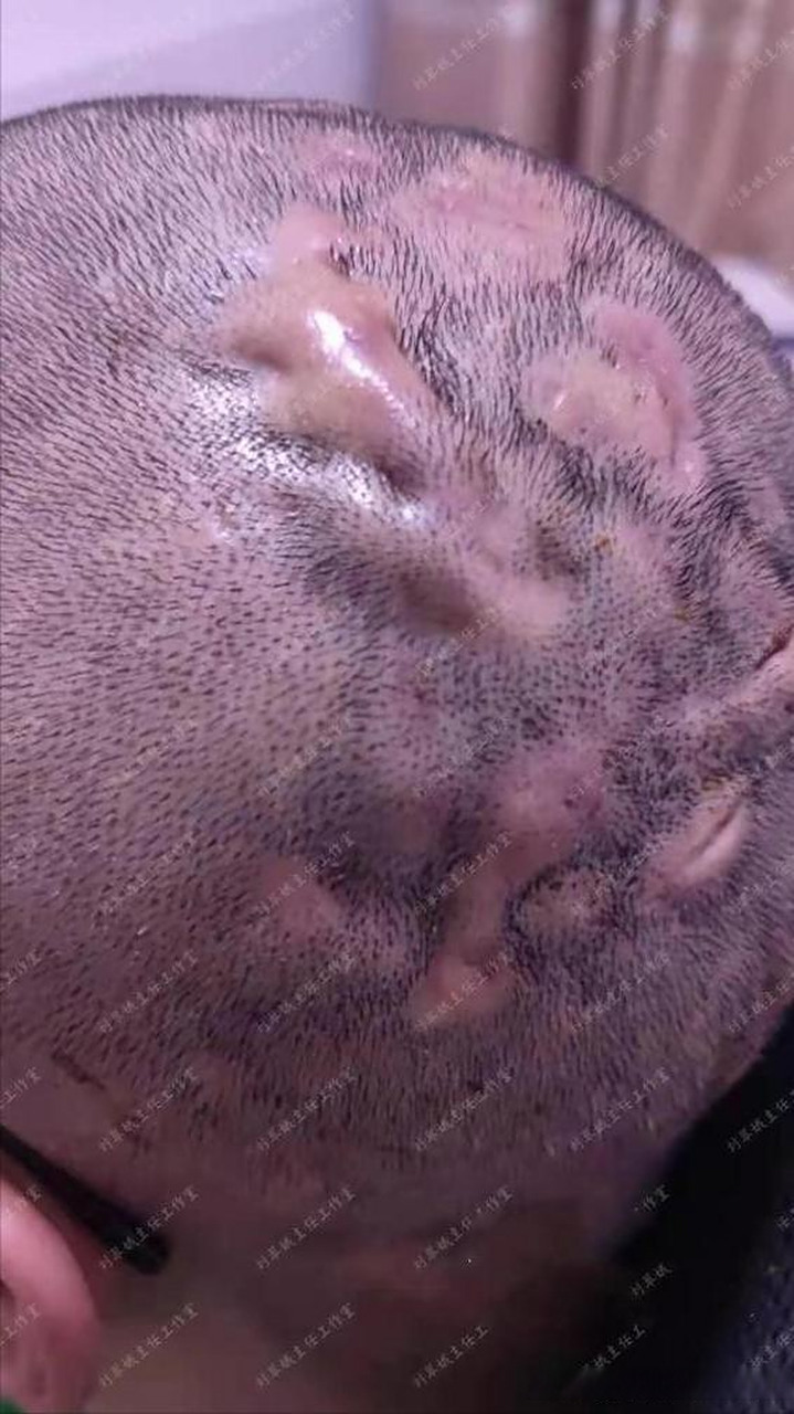 头上大包破溃流脓,中医辨证为热毒,红肿疙瘩全消除!