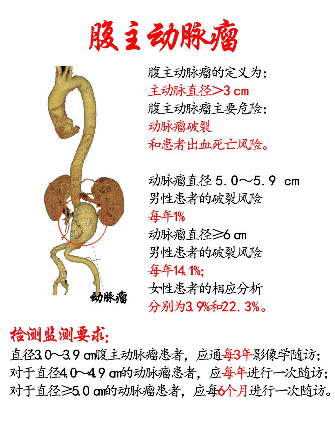 腹主动脉瘤,主动脉夹层,医学知识科普 腹主动脉瘤,发病隐匿,具有较高