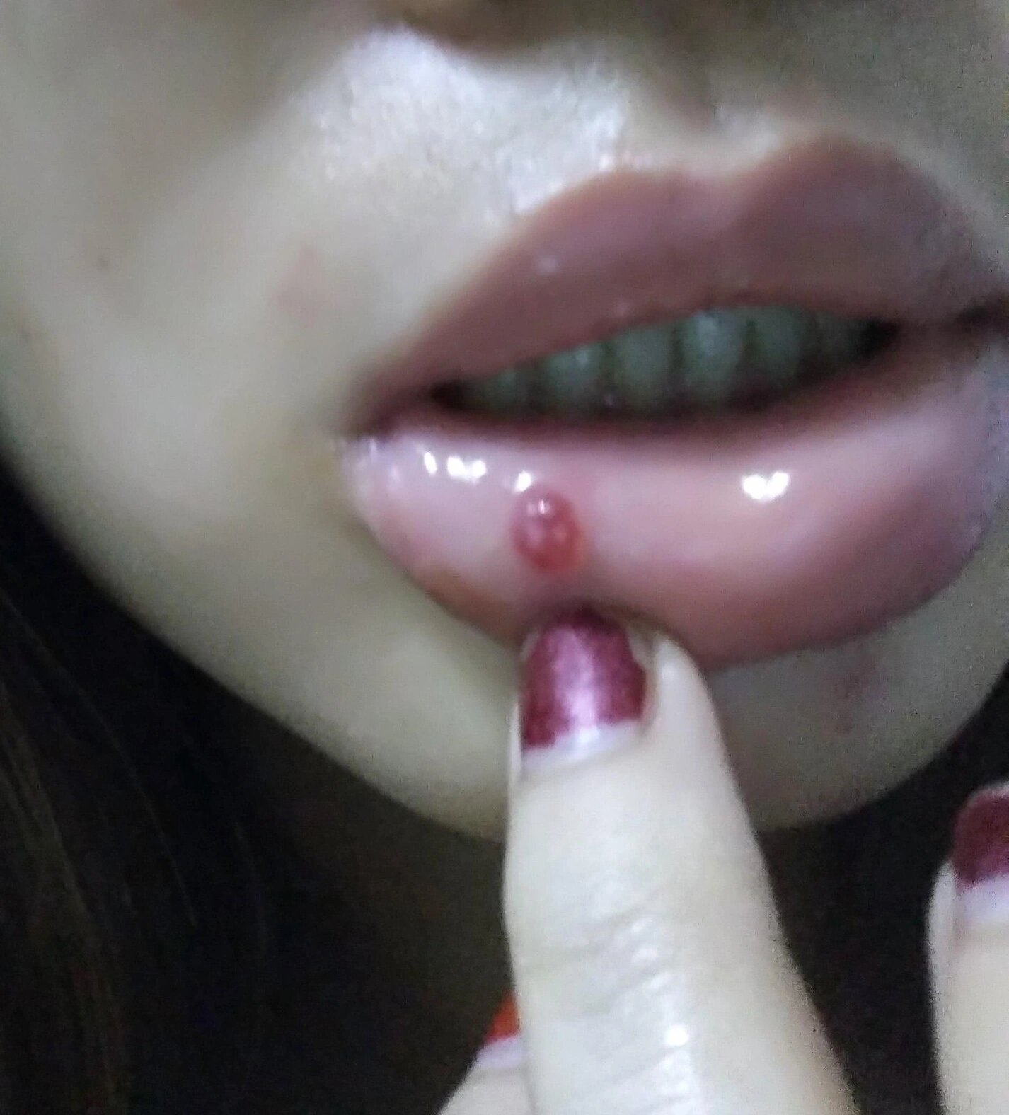 送给有缘人|我的粘液腺囊肿自愈了