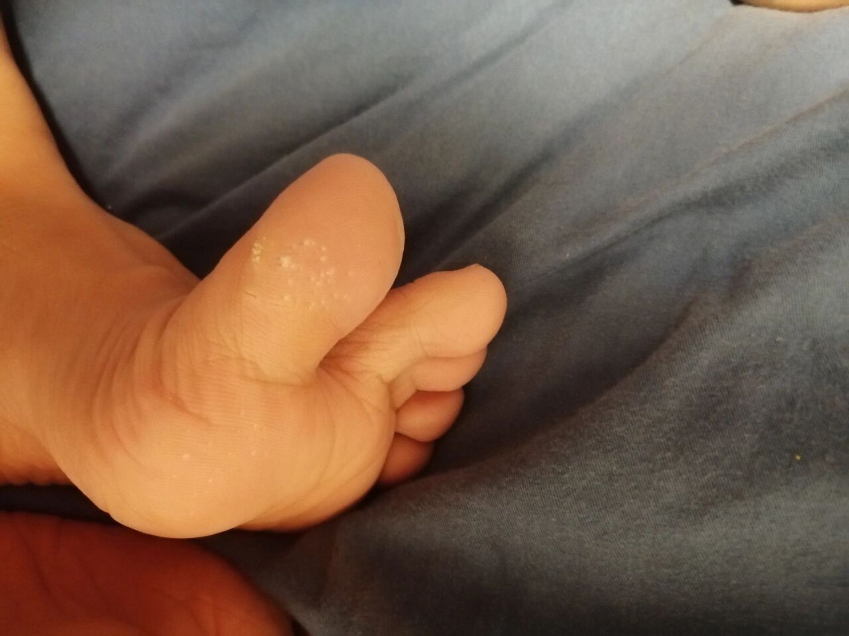 大母脚趾很多倒刺怎么回事? 一直这样,我属于干脚,其他地方没有.