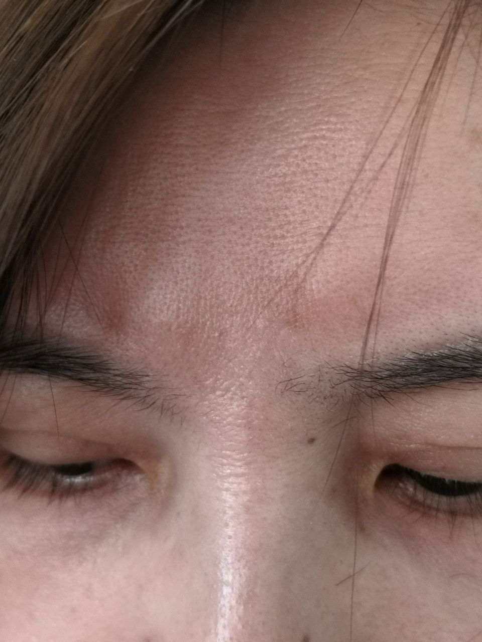 炎症后色素沉着.