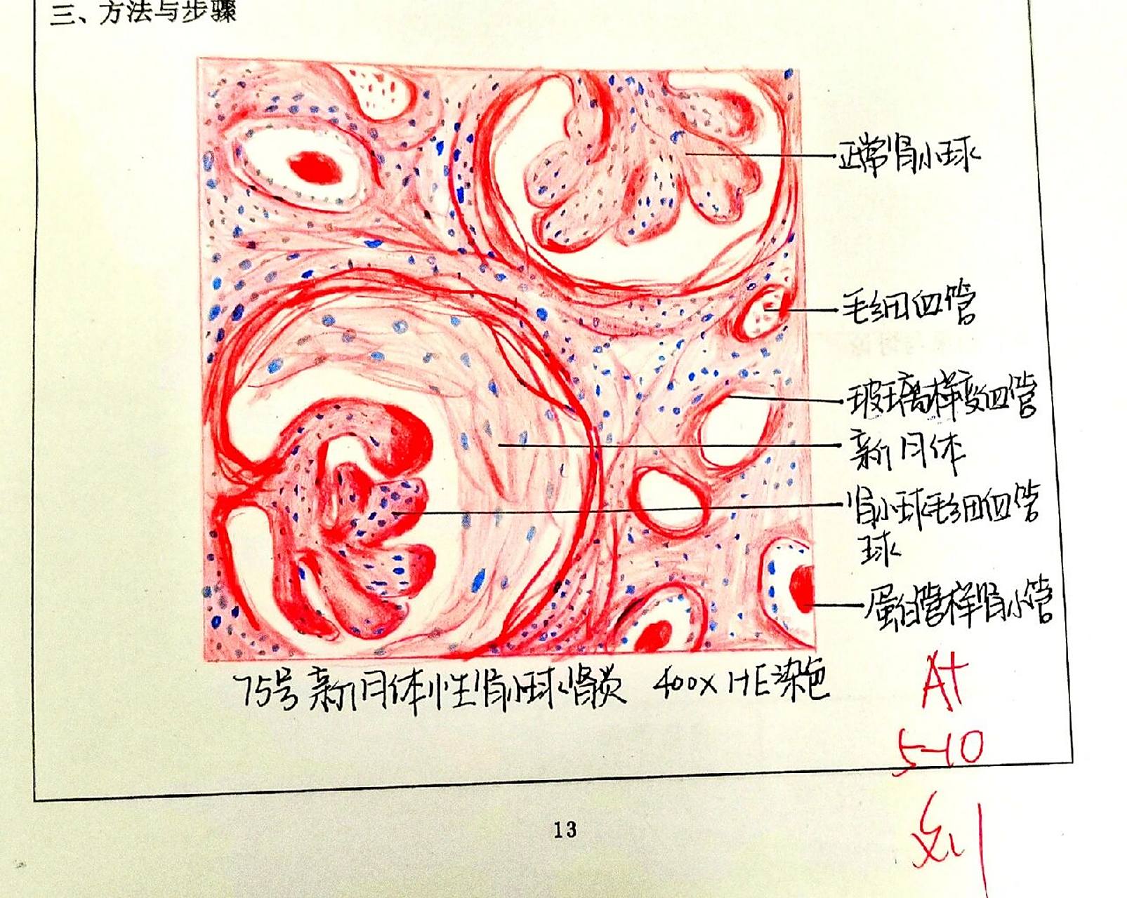 性肺结核 p3慢性胃溃疡 #医学生考试月# #医学生笔记# #红蓝铅笔绘图