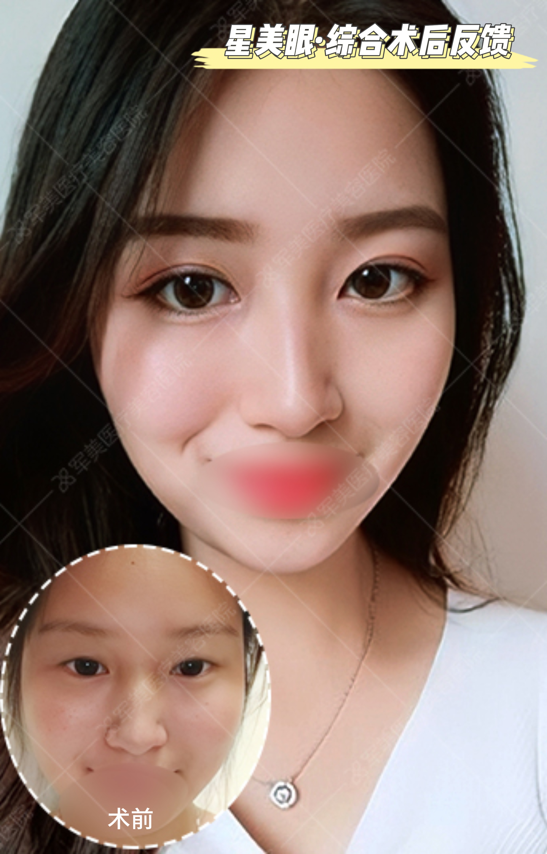 而双眼皮从视觉上会增大眼睛的轮廓,增添双眼