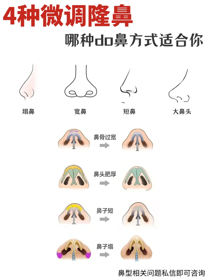 宽鼻 鼻骨过宽  对鼻部进行截骨