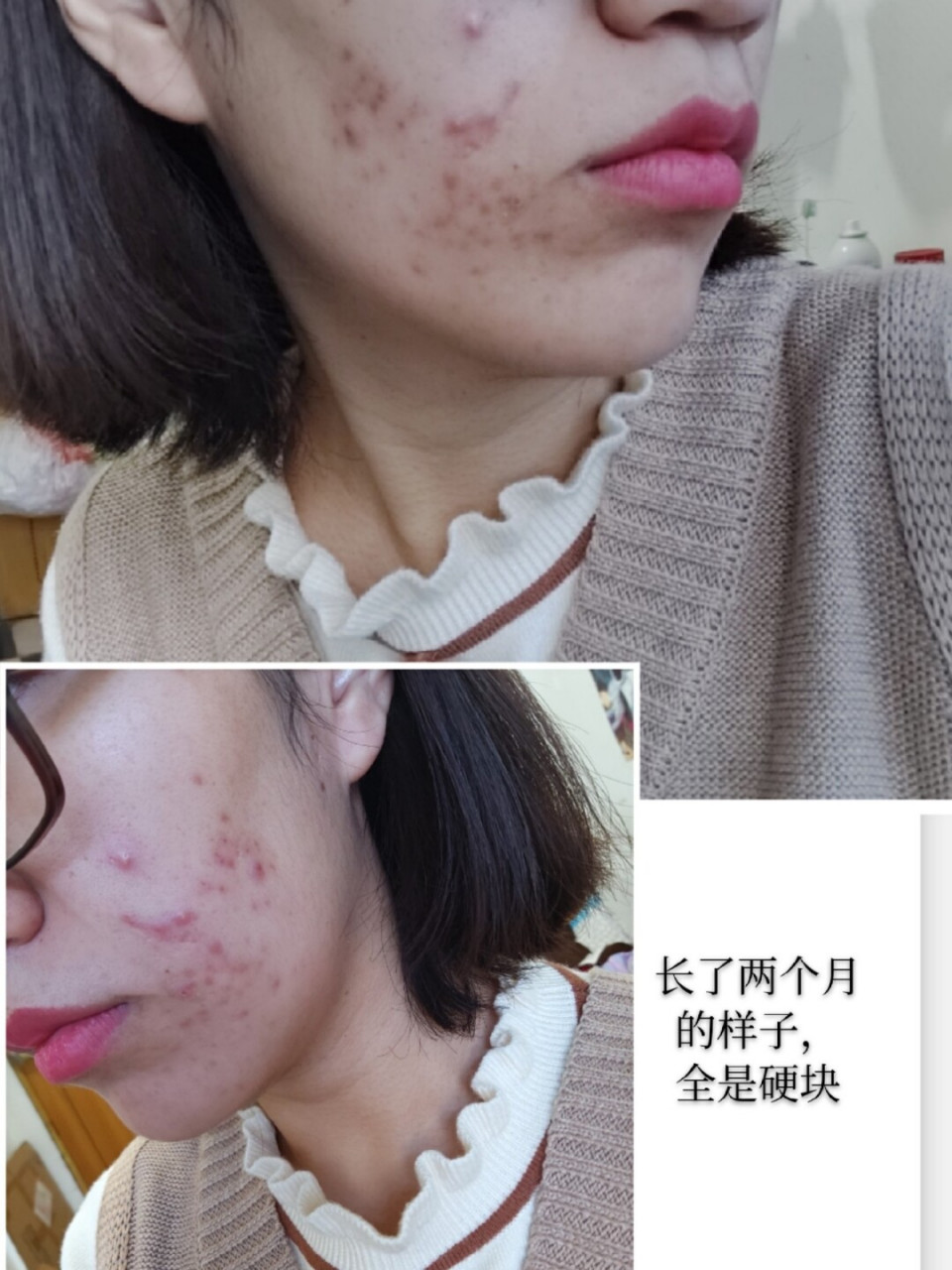 来说一说我囊肿型痘痘的治疗之路! 我是个大油皮,还非常容易长痘.