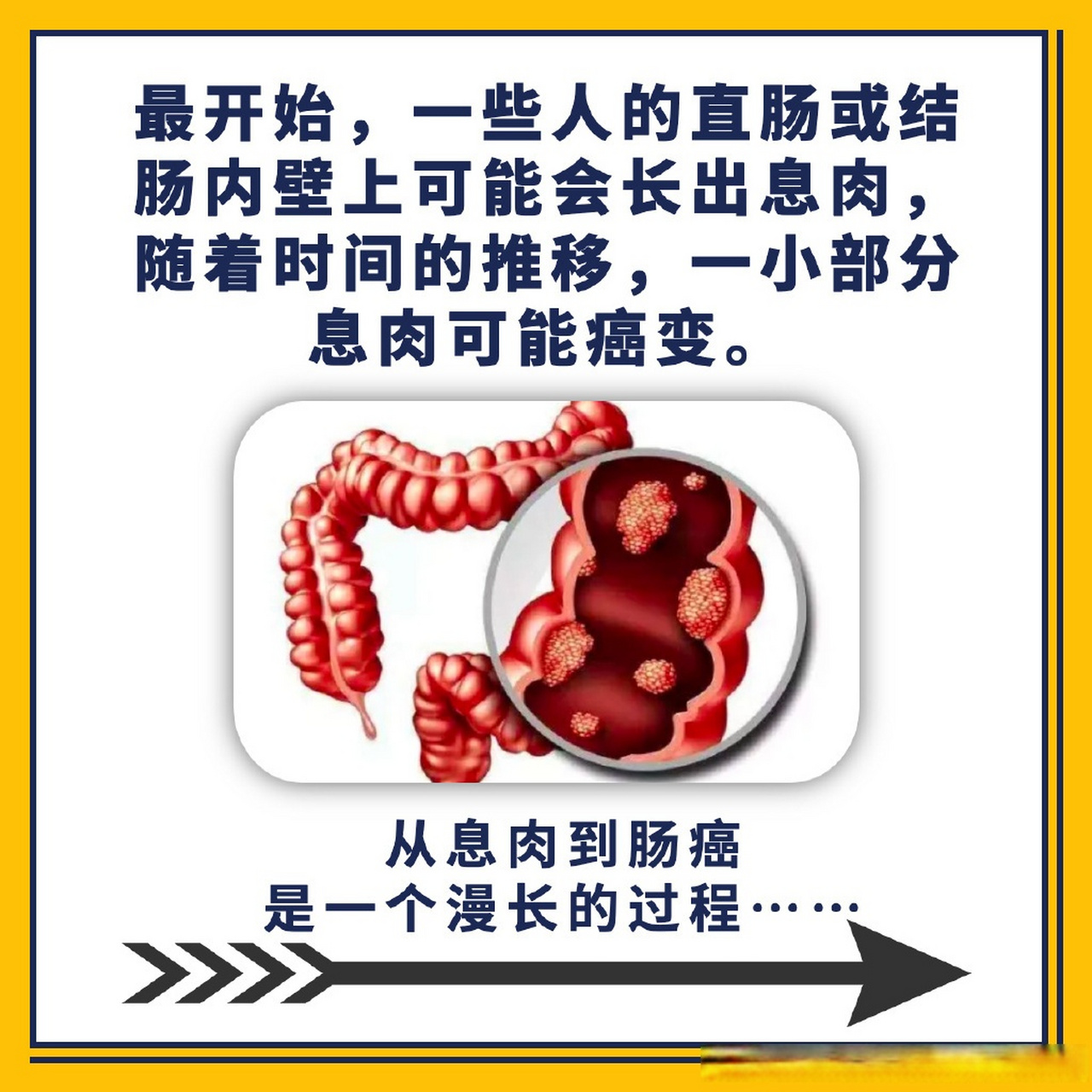 肠息肉是怎么一步一步转变为结直肠癌的呢?
