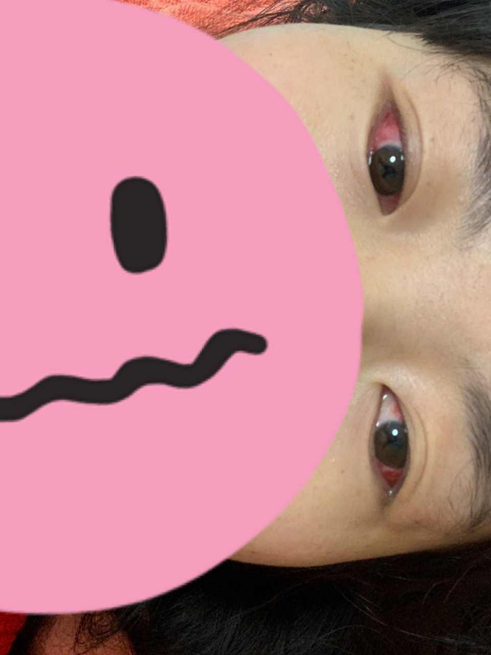 斜视手术后第二天 北京同仁医院 3月18号,早上8点40到东区6层办理住院