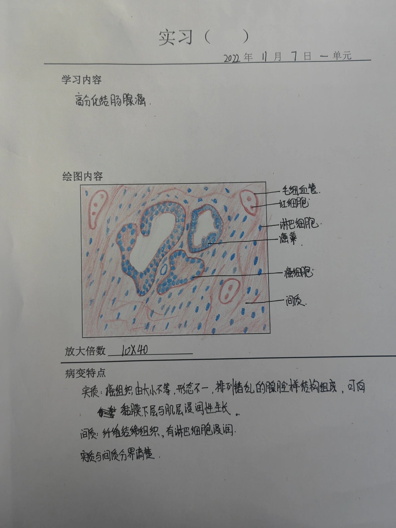 肠腺癌 红蓝铅笔图片