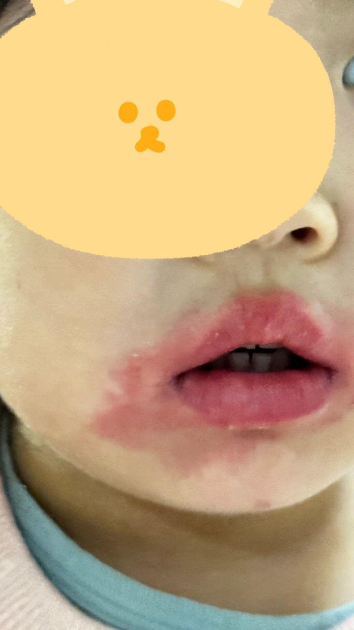 终于找对了口周湿疹的"偏方" 我崽崽的口周湿疹,已经持续一年了.