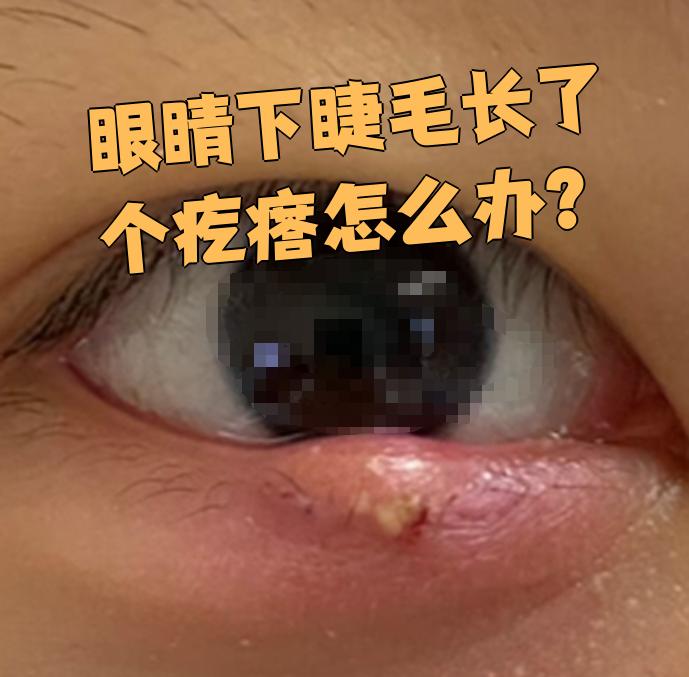 眼睛下睫毛长了个疙瘩,建议先去医院检查清楚原因,再针对具体问题