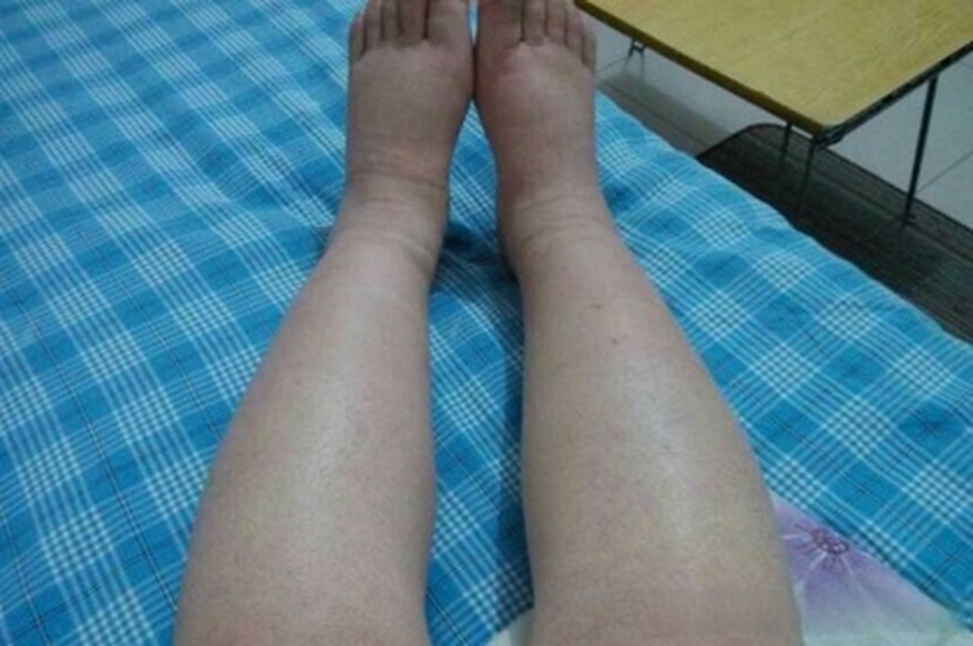 她颜面及双下肢浮肿3年不重视,近来因胸闷憋气,水肿加重,检查发现血