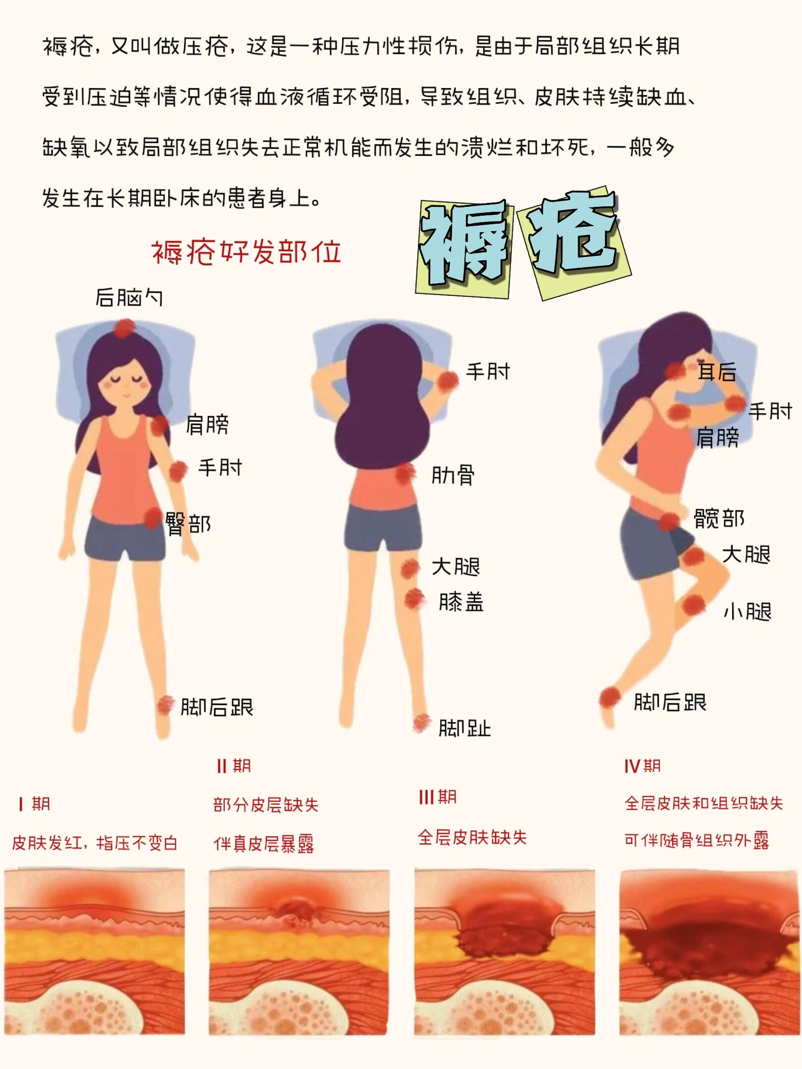 褥疮医学科普文