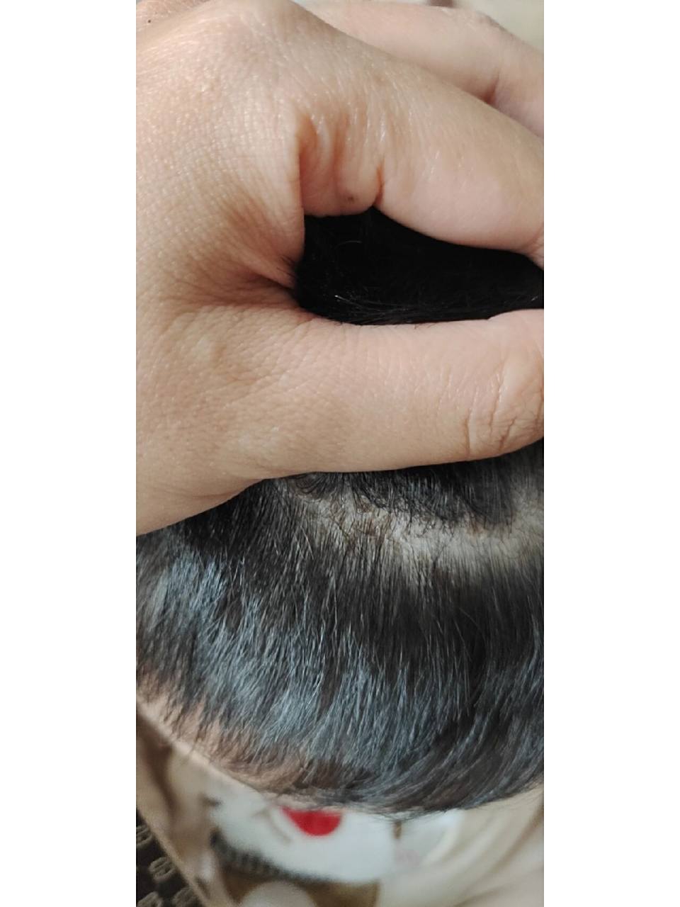 宝宝头顶上有一片黄色的结痂 今天才注意到头发里面有黄色结痂 不知道