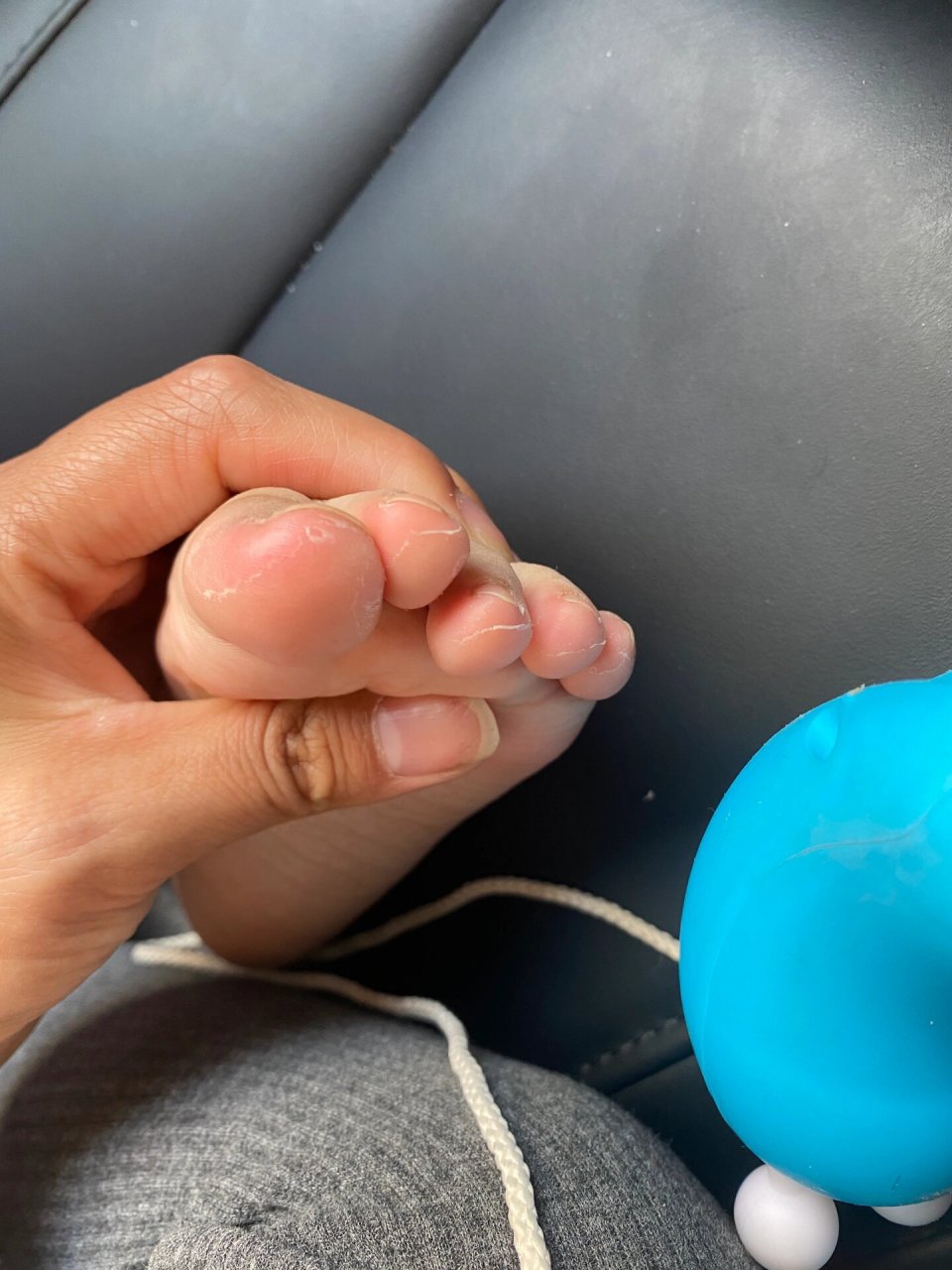 孩子脚趾头蜕皮了,不知道啥情况 十个指头都这样,好奇怪