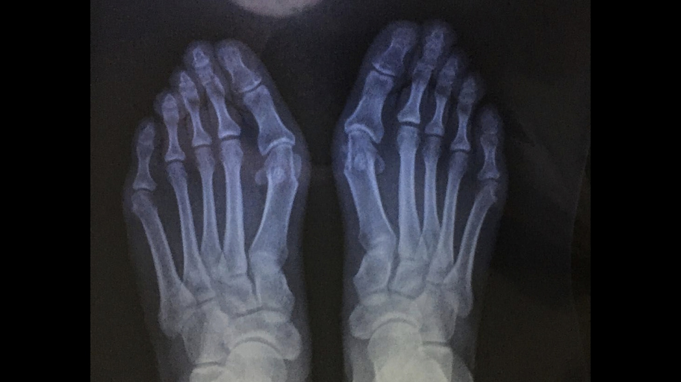 x光片更直观了解大脚骨 如果单纯去掉凸起能否有效矫正拇外翻呢?