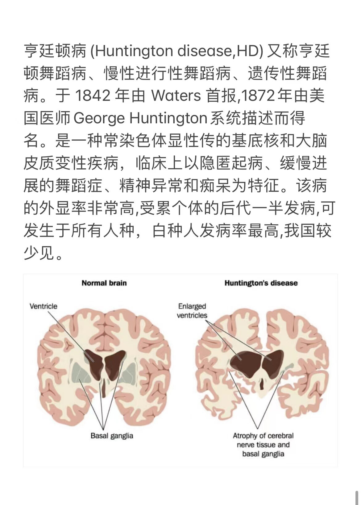 病 16615 亨廷顿病(huntington disease,hd)又称亨廷顿舞蹈病
