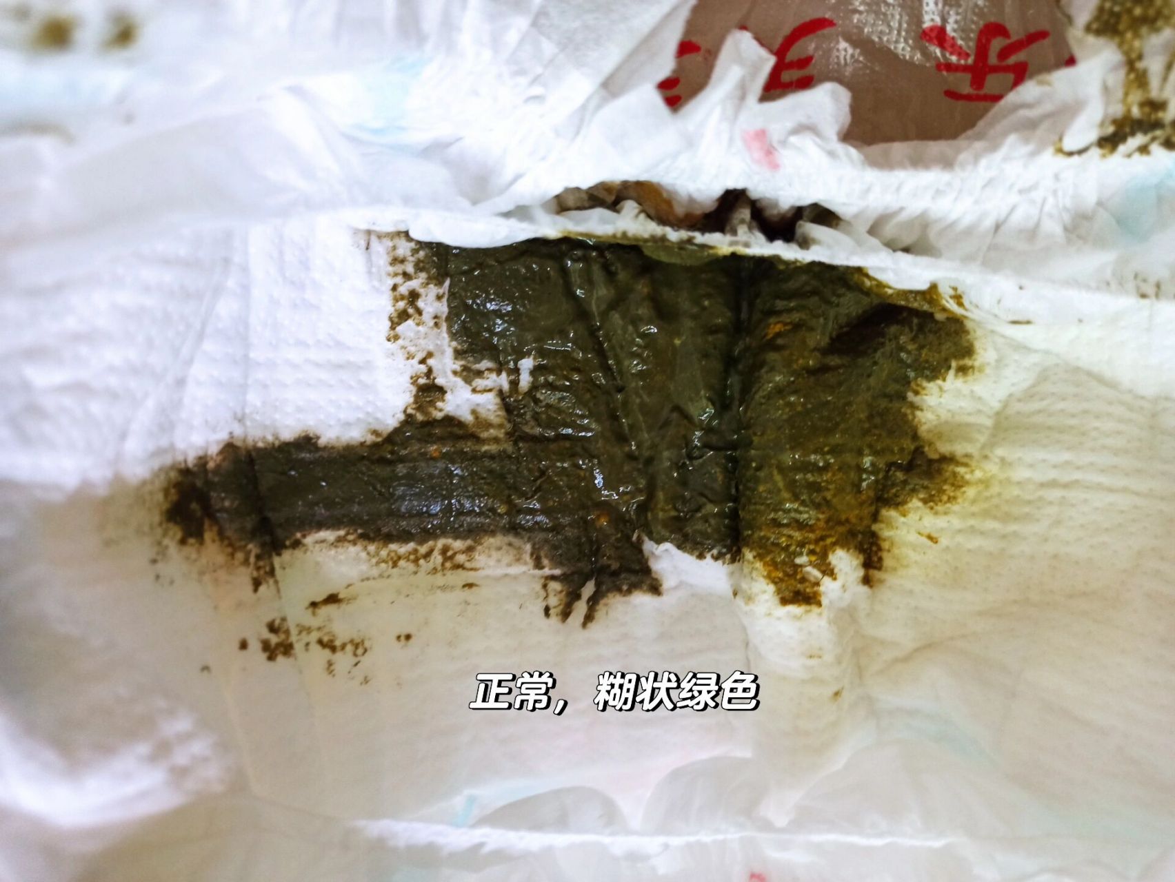 宝宝进食氨基酸配方粉初期,大便颜色有可能会有些变化,如变为黄褐色