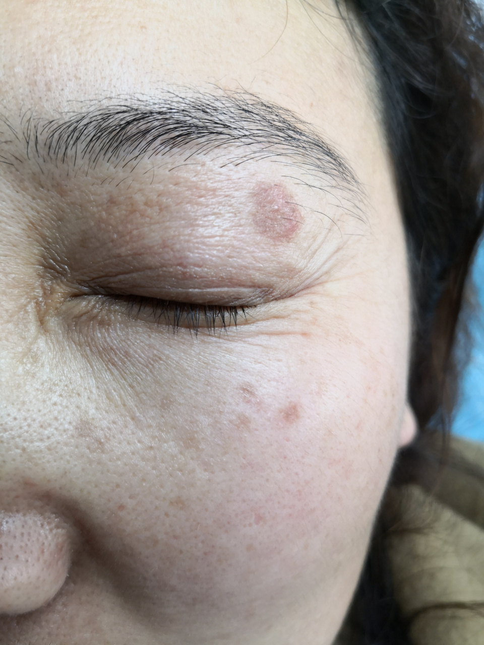 炎症后色素沉着可以使用激光治疗修复祛除色素.