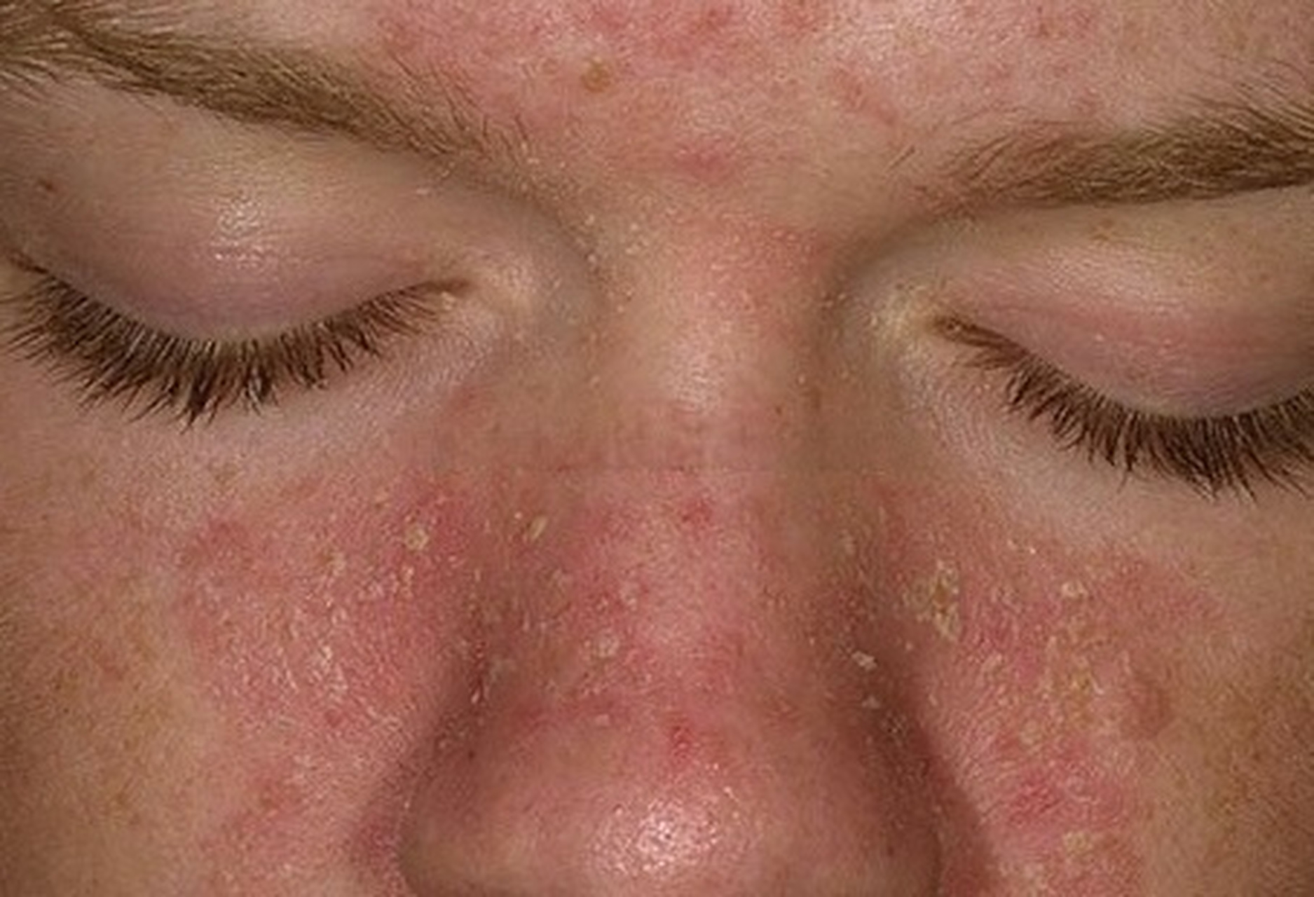 面部脂溢性皮炎初期图片