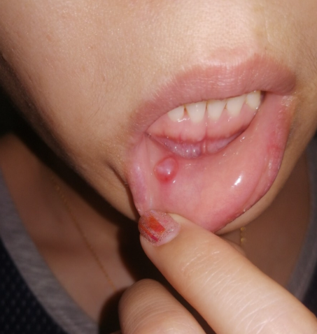 嘴里长个肉疙瘩可能有很多原因,最常见的是良性囊肿,恶性肿瘤,上火