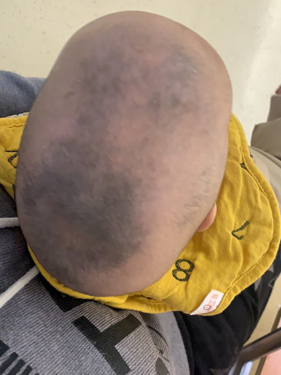 颅缝早闭 宝宝出生就头型不对,后来越来越长,两侧狭窄,额头突出,像