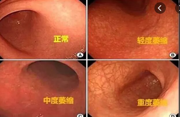 萎缩性胃炎能不能吃水果?