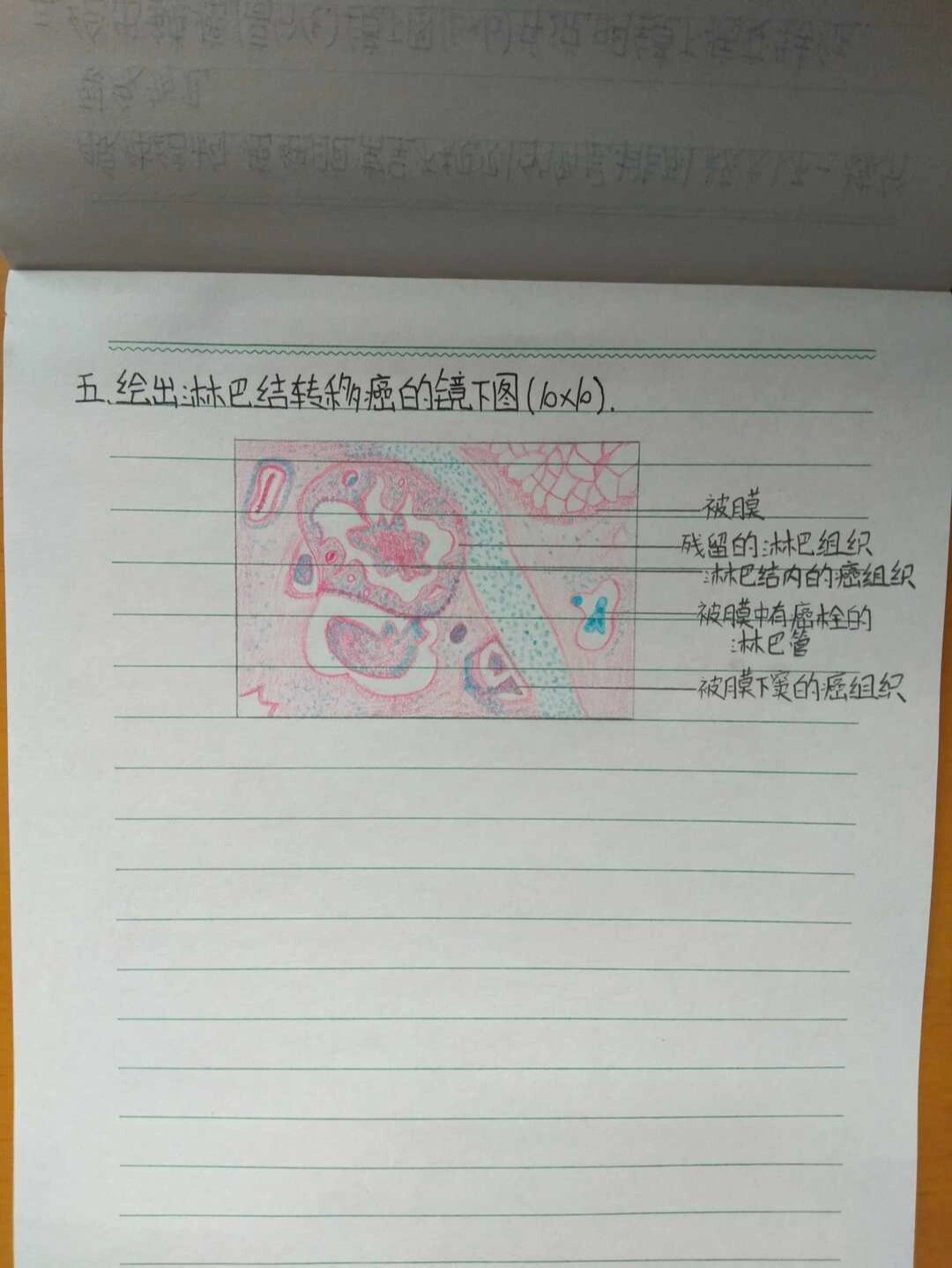 病理/淋巴结转移癌/手绘图
