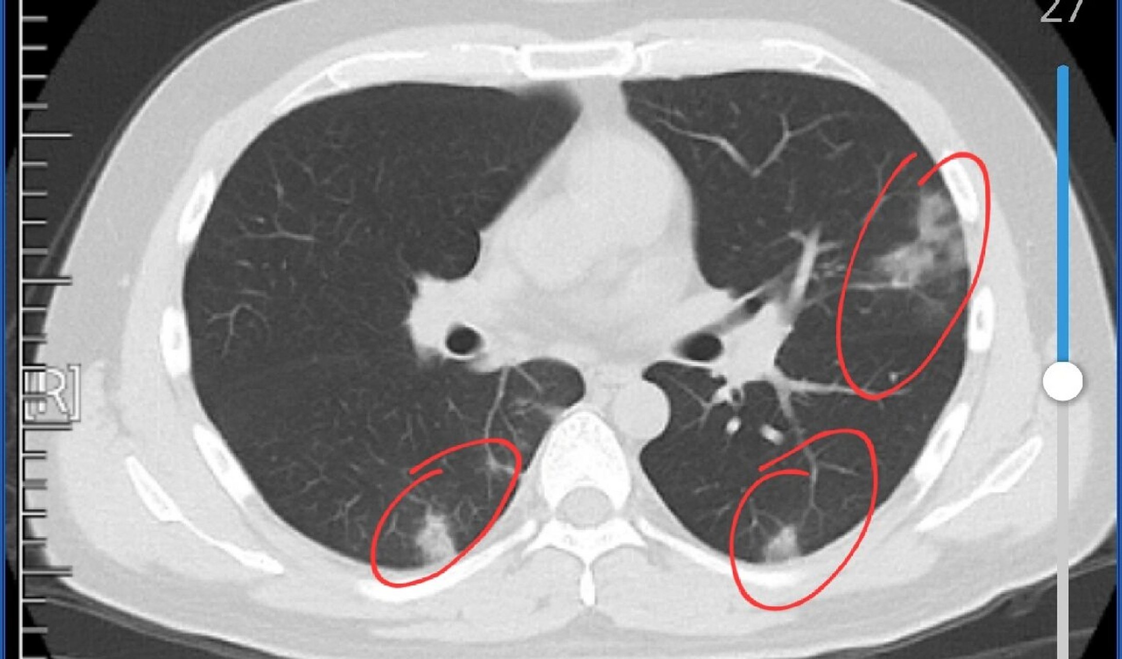新冠阳性后的一个患者肺部ct表现,呈磨玻璃样改变,为病毒性肺炎