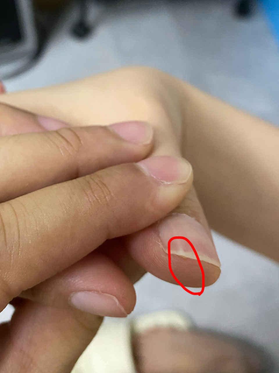 指甲内部长白条 初高中的时候,有次不小心弄伤之后,就一直从指甲根部