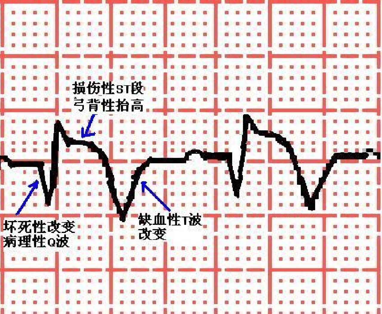 急性心肌梗死心电图波形及演变