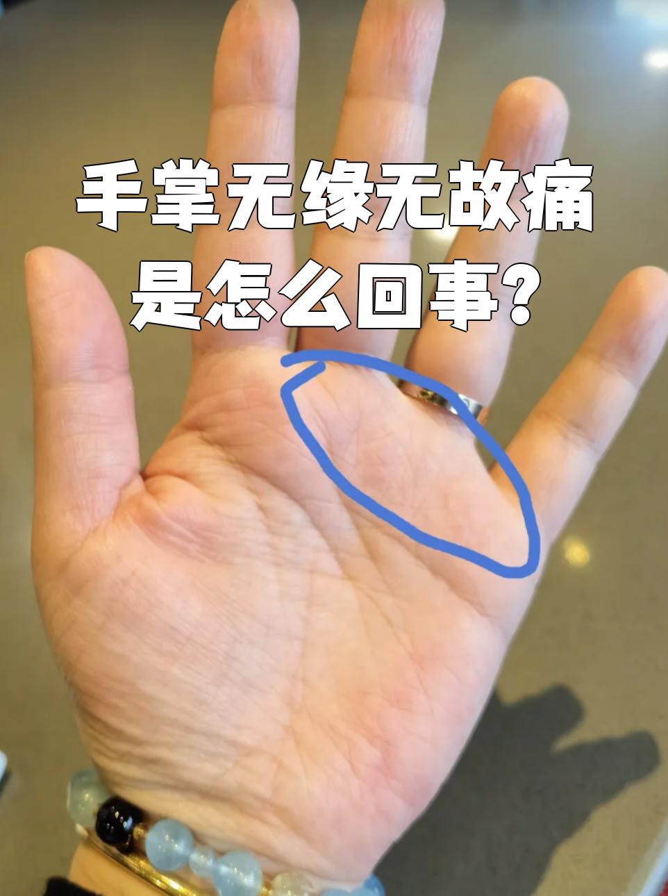 手掌突然疼但找不到原因,可能是这几种情况: