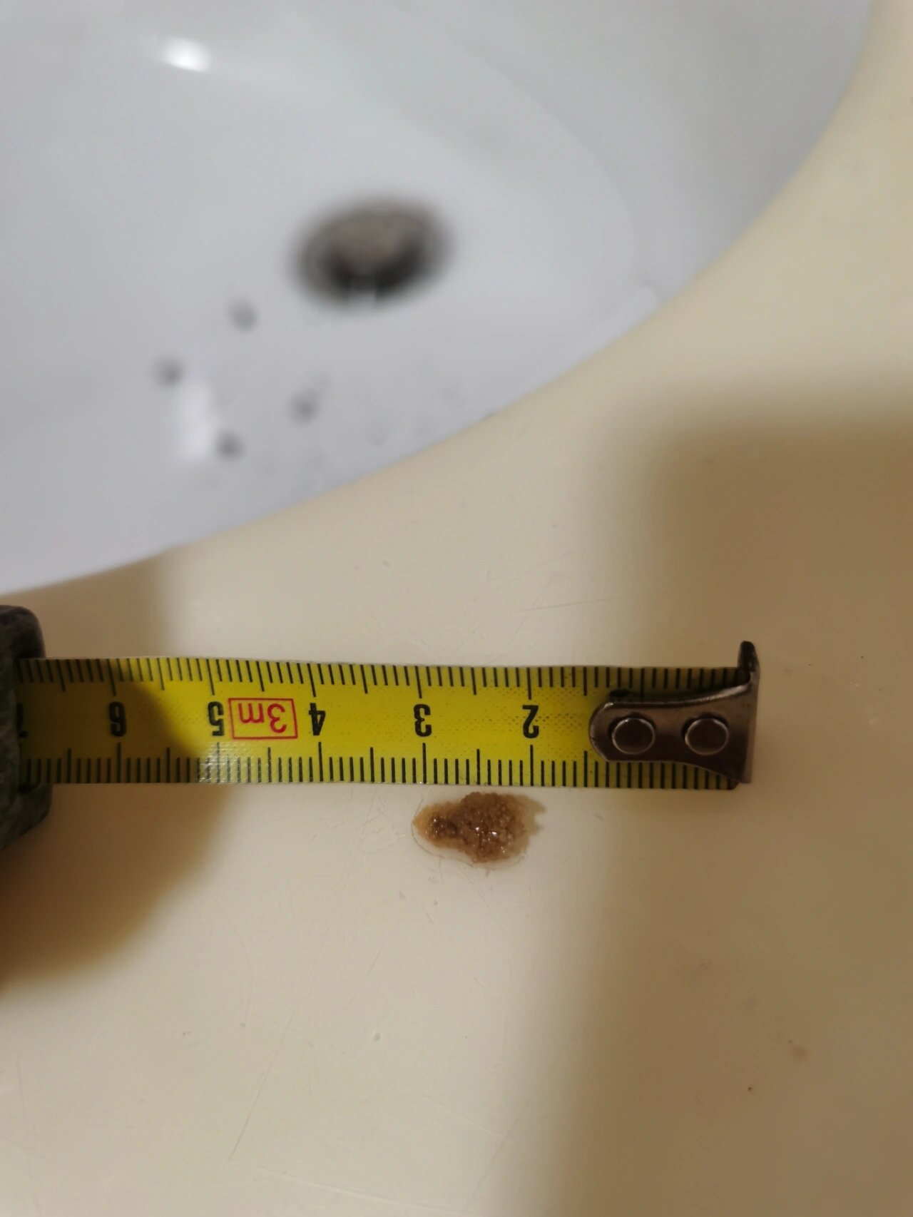 历时一个月,12*7mm结石终于出来了 上个月19号下午