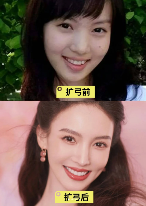 翻了翻牙齿矫正过的明星们,有不少正畸扩弓的,扩弓之后会让笑容更加