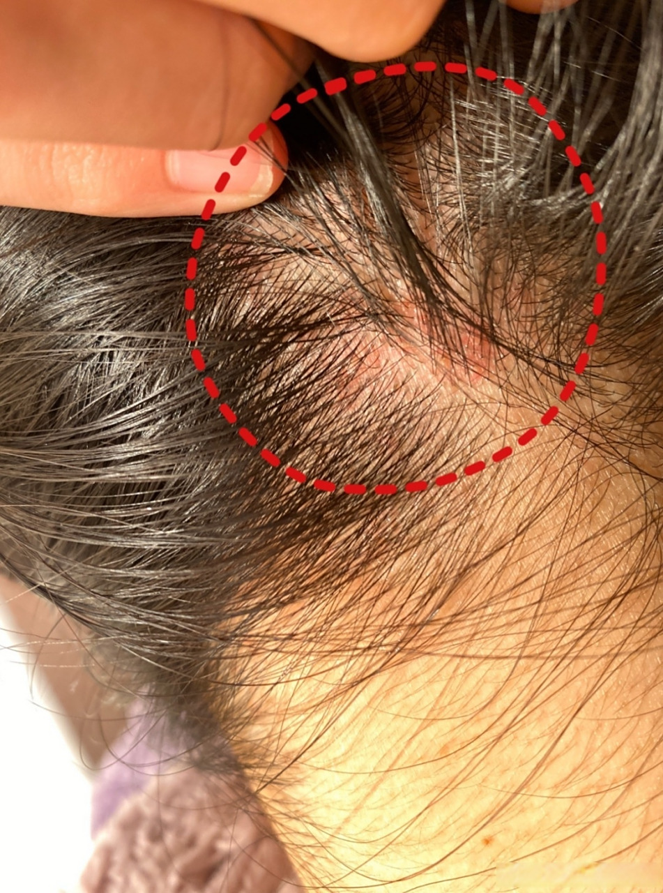 毛囊炎 多为红色,随着炎症的发展疙瘩会越长越大,还会形成囊肿,92挠