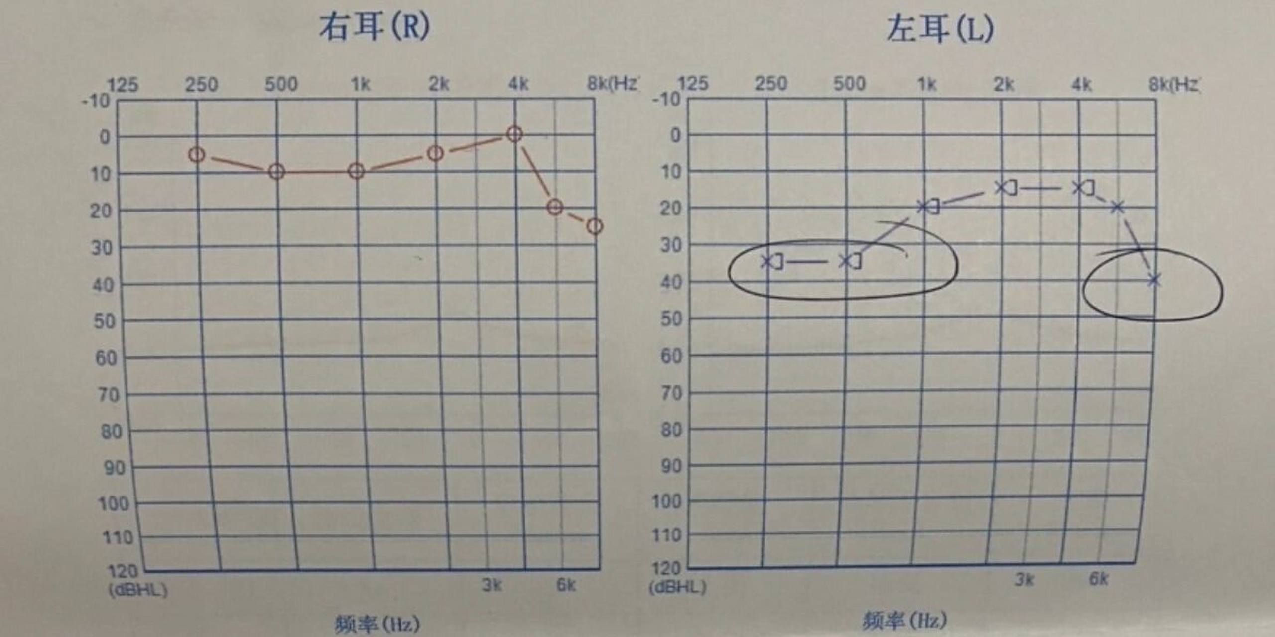 正常的听力阈值,气导值应小于20db,骨导值应在0db左右.