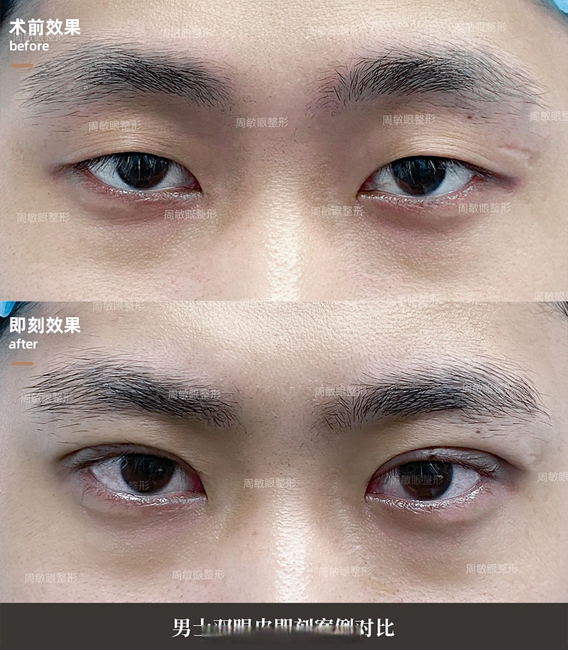 男士双眼皮案例分享 男生的双眼皮做法跟女生不同,弧度不宜夸张,宽度