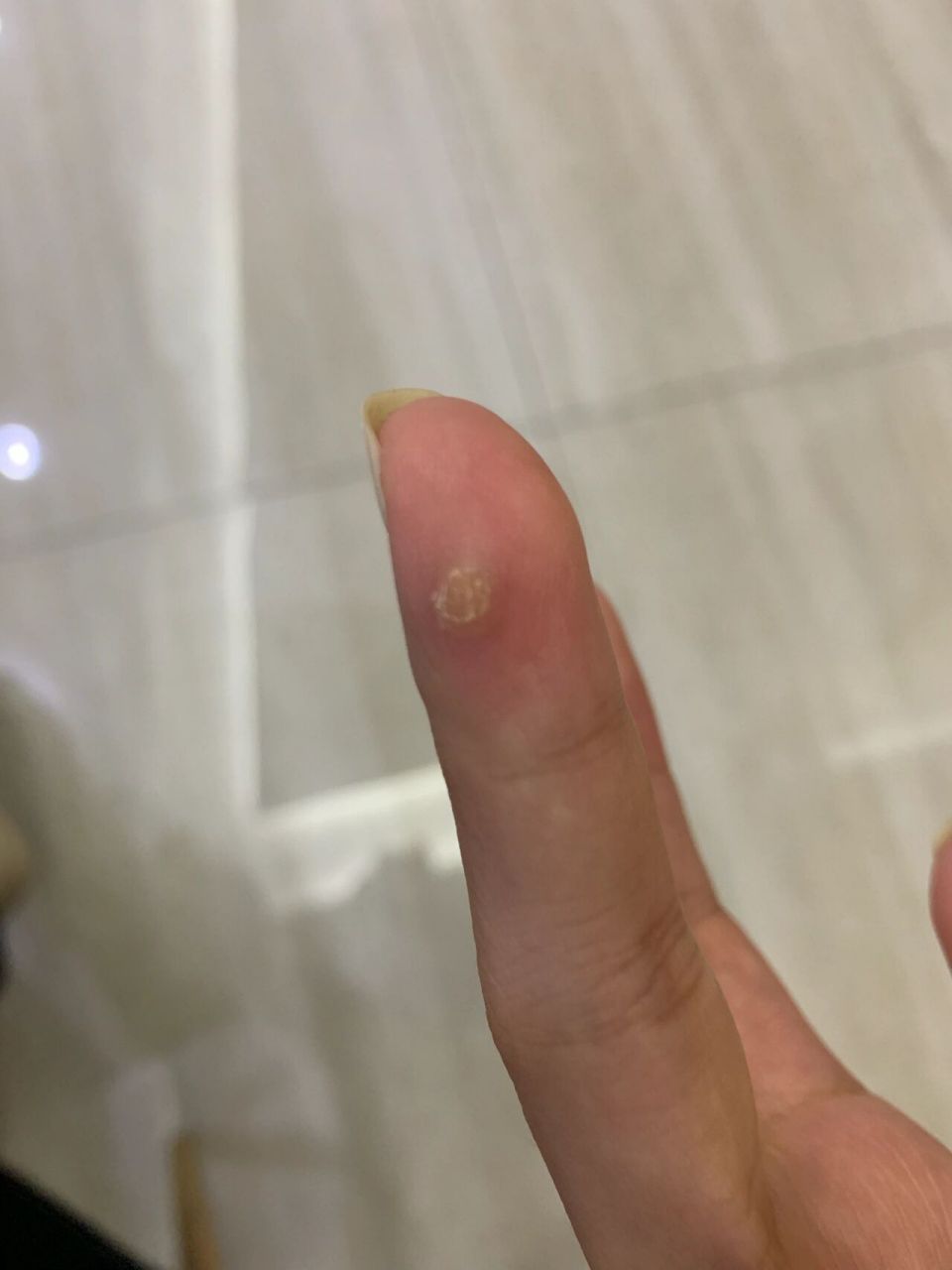 手上长得是鸡眼么,擦了很多药剪了很多次还是长,求求治疗方法