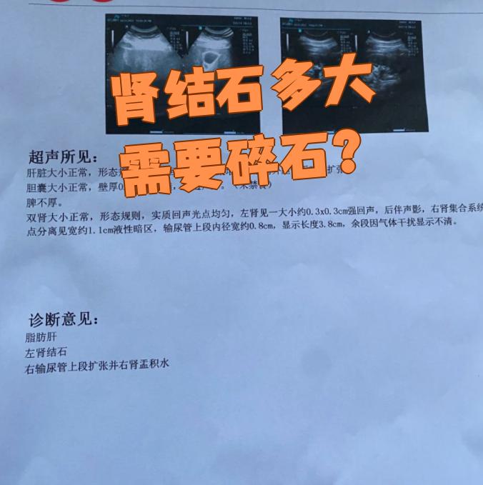 肾结石多大需要碎石?这要看结石的具体大小