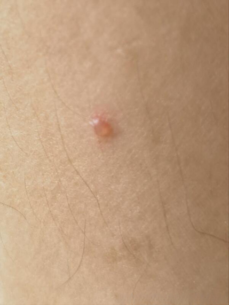 女36岁, 从小手脚汗多,每年都长汗疱疹,这次汗疱症第一次好了以后,不