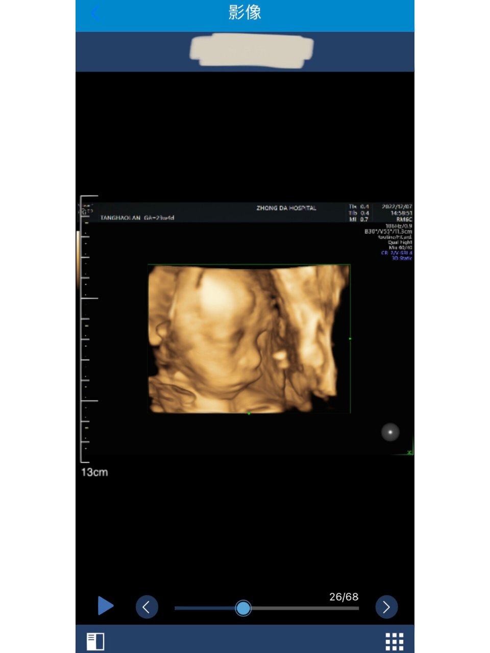 三维彩超大排畸通过啦 孕23周 4的时候,在南京中大医院做了三维彩超