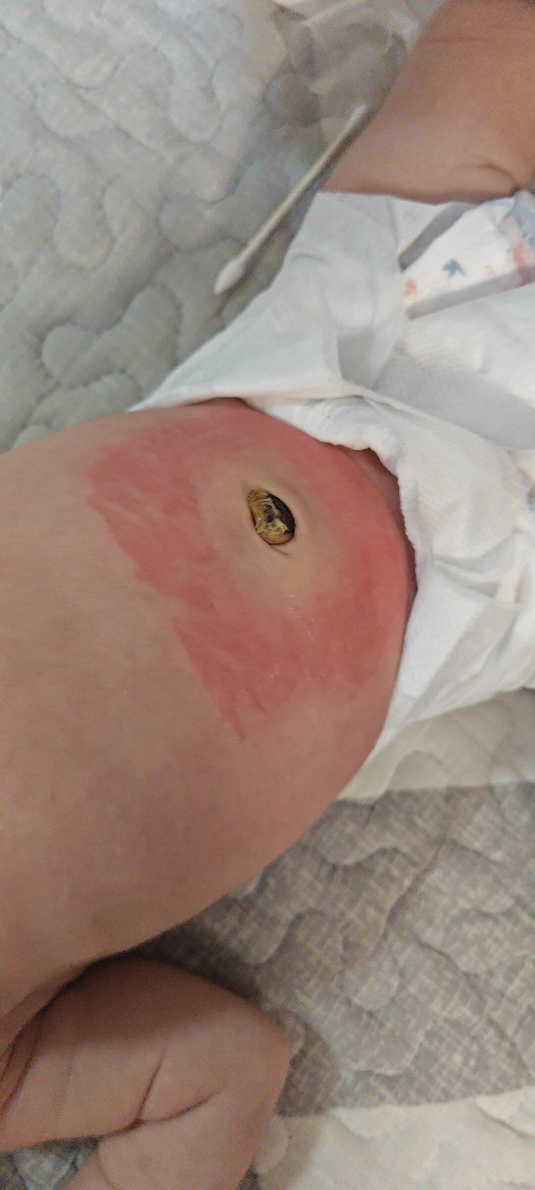 新生儿可以不用肚脐贴!