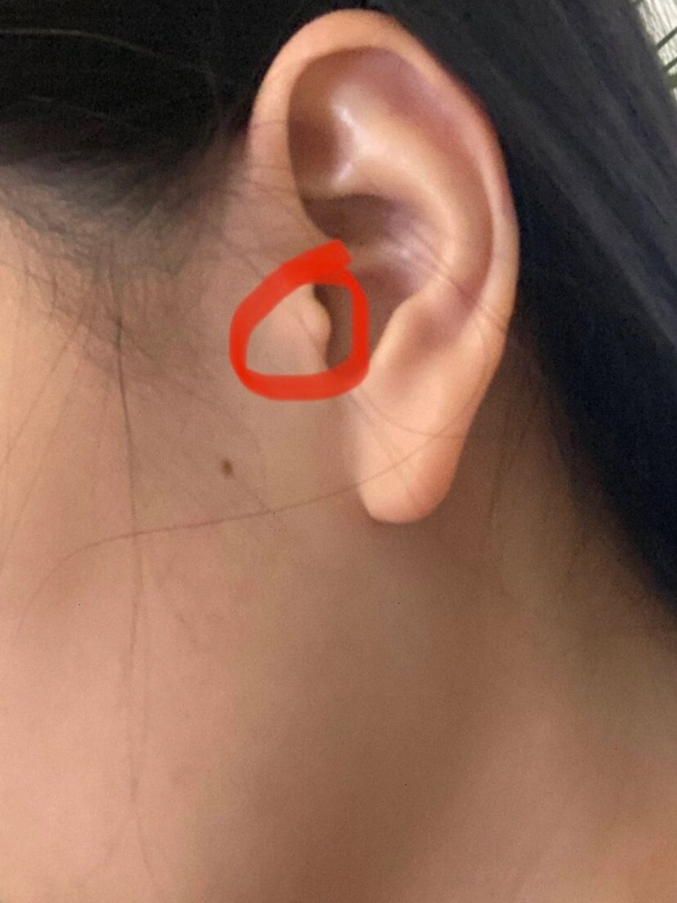 耳闷,怎么解决 快速按压耳屏3～5分钟,每天3～5次,试试