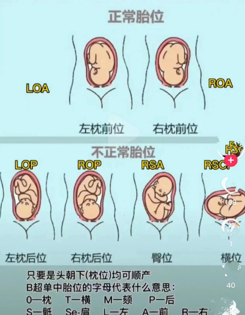 胎位LOA与LOT的区别图片