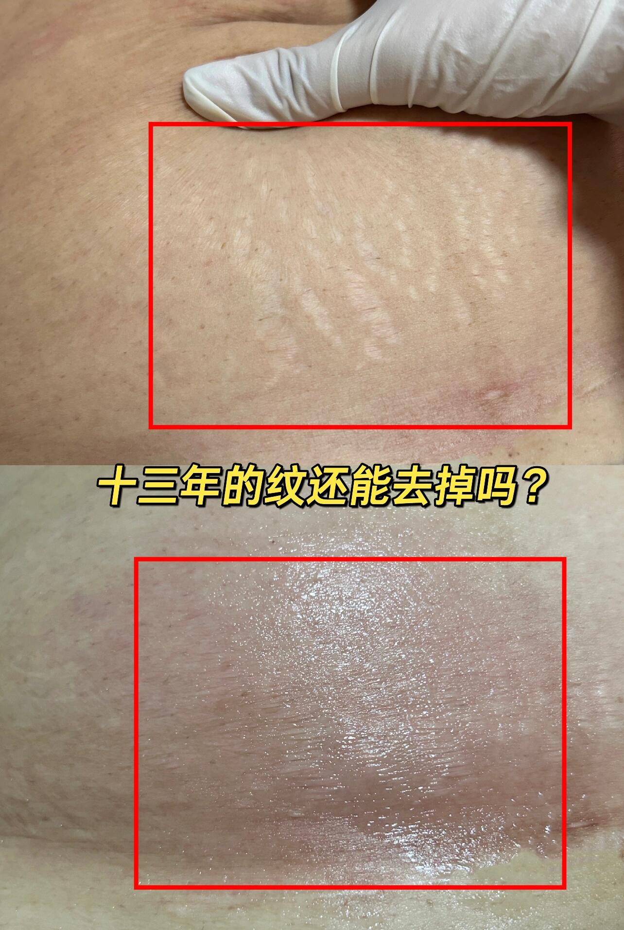 两个孩子的宝妈,困扰了十三年的妊娠纹 咨询过很多,也尝试过微针,没