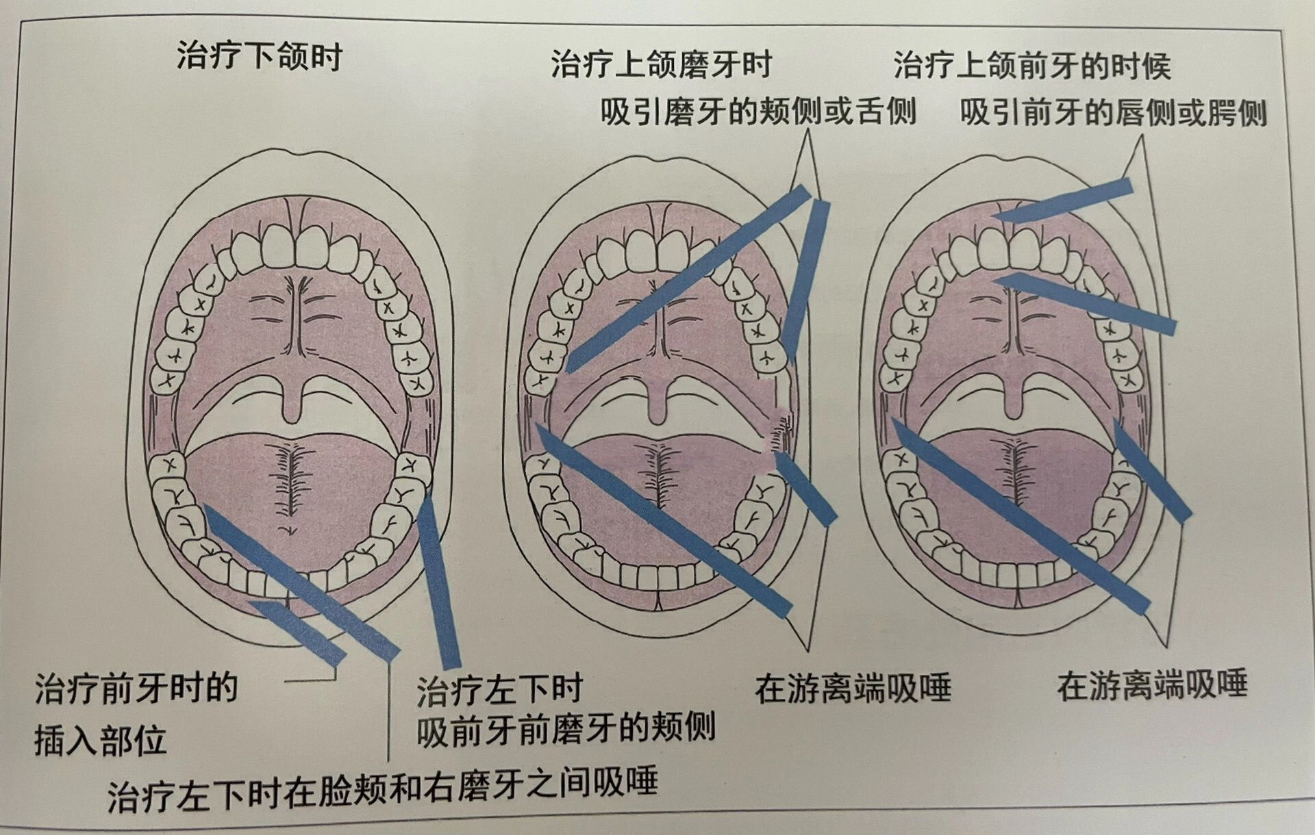 口腔按摩手法图片